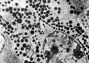 F, 41y. | acromegaly - acidophilic pituitary adenoma (STH) F, 41y. | acromegaly - acidophilic pituitary adenoma (STH)